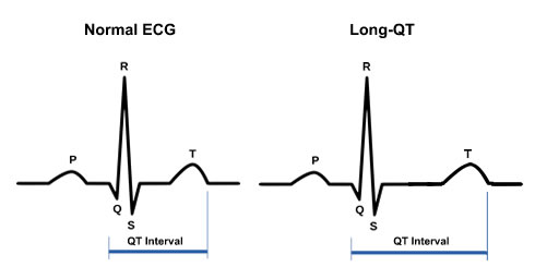 Hypertrophic Cardiomyopathy