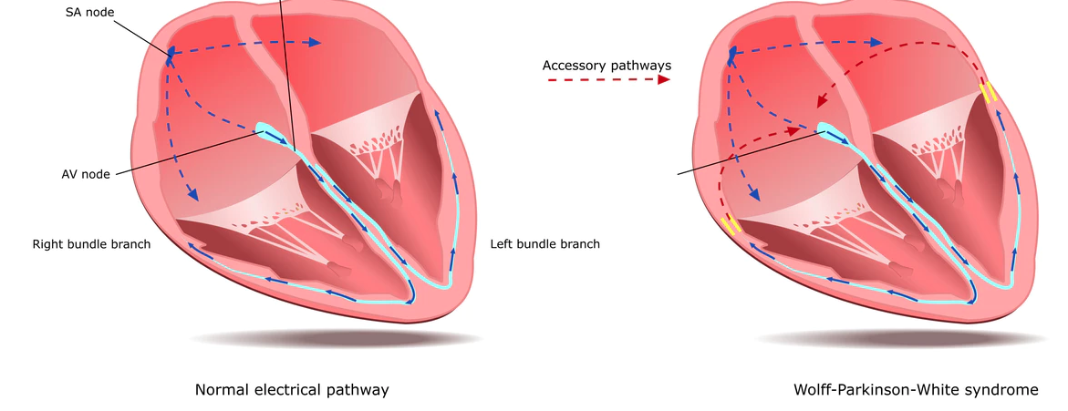 Wolff-Parkinson-White Syndrome